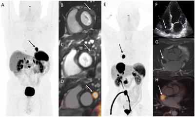 Detection of cardiac neuroendocrine tumour metastases by somatostatin receptor PET/CT: a systematic review and meta-analysis